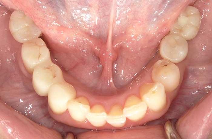 完成後の口腔内写真