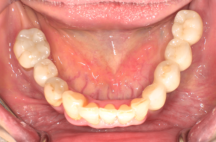 完成後の口腔内写真