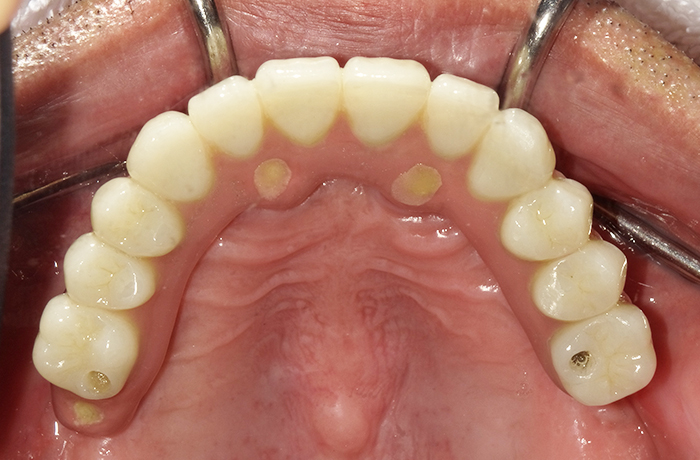 完成後の口腔内写真