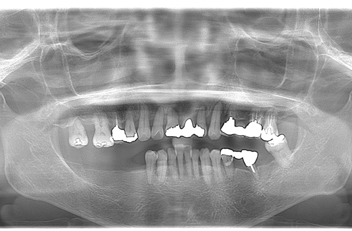 口腔内写真
