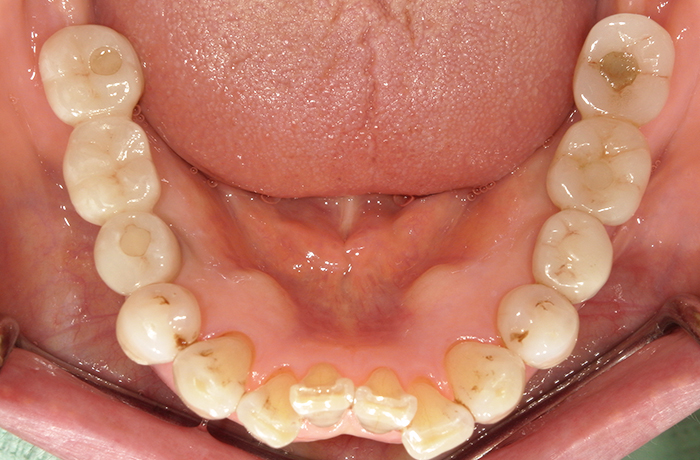 完成後の口腔内写真