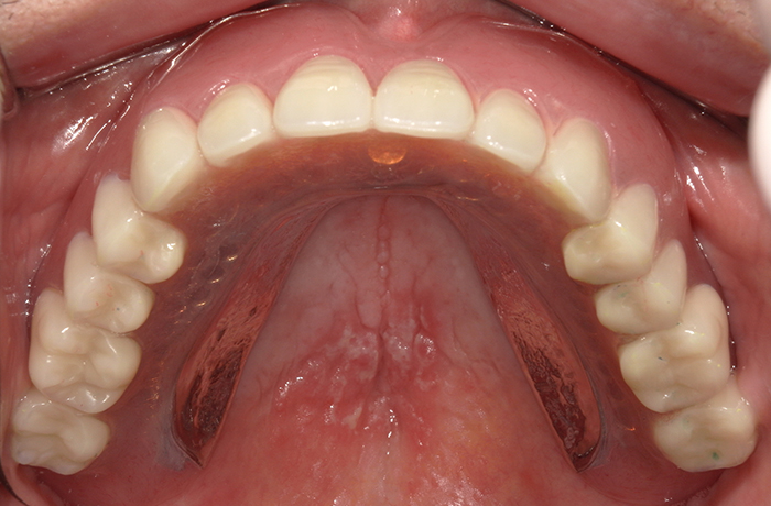 完成後の口腔内写真